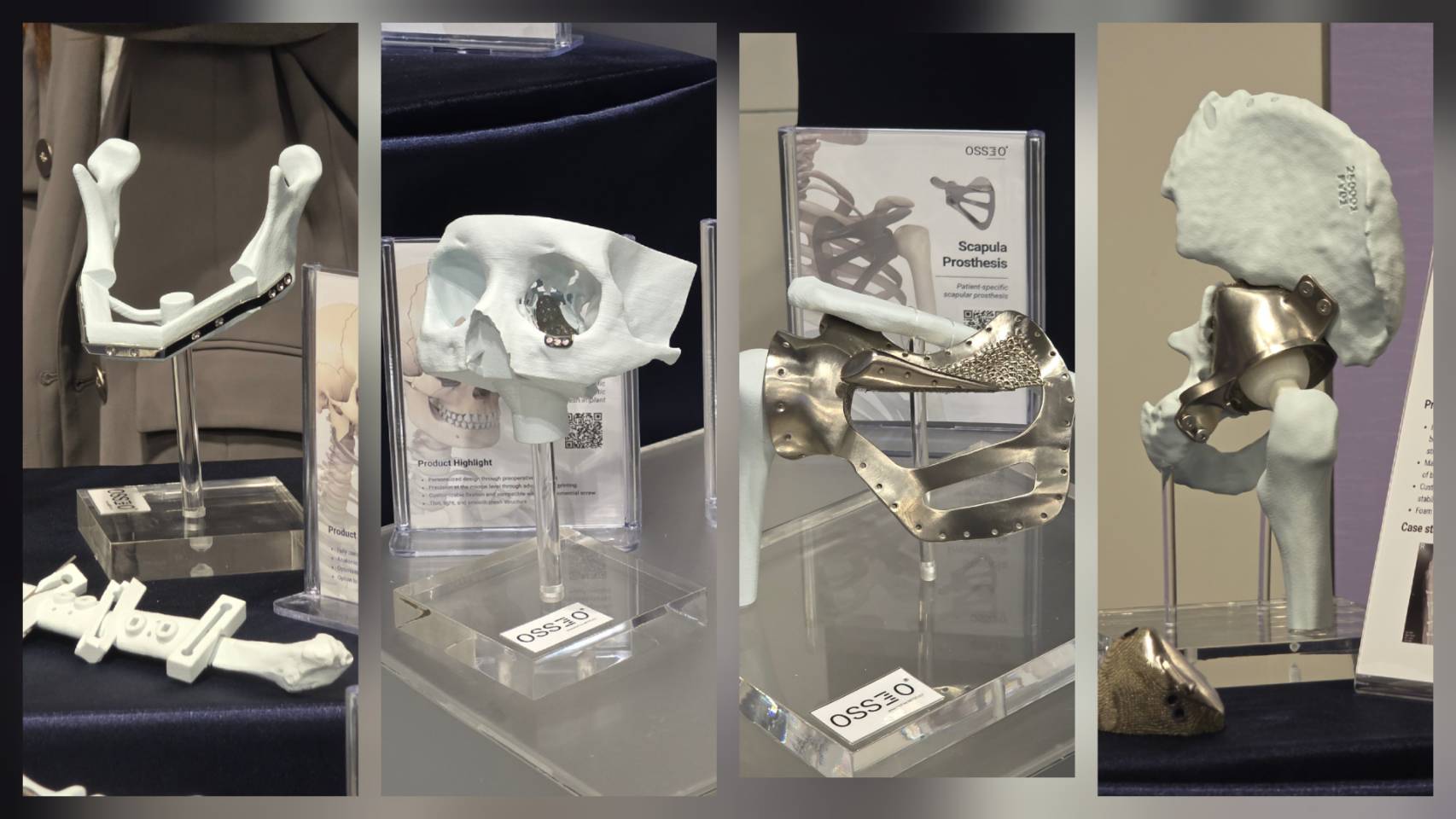 11 ตัวอย่างกระดูกไทเทเนียมจากการพิมพ์สามมิ